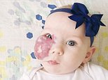 Mom of girl with a red birthmark across her face slams strangers who comment