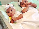 Conjoined twins who shared spine separated in NY