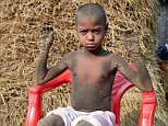 The boy who is turning into stone due to a rare condition
