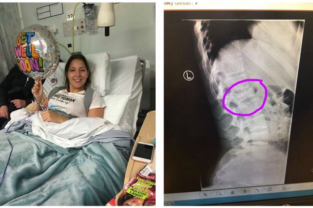 Gwynedd student nurse left with crushed vertebra in trampoline park horror
