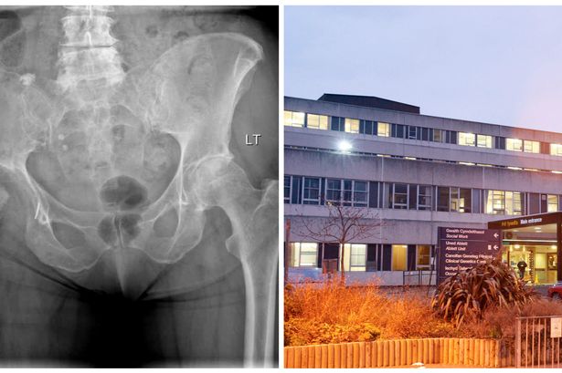 North Wales patients waiting TWO YEARS for hip surgery at Ysbyty Glan Clwyd