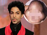 Explained: The genetic disorder that killed Prince's son