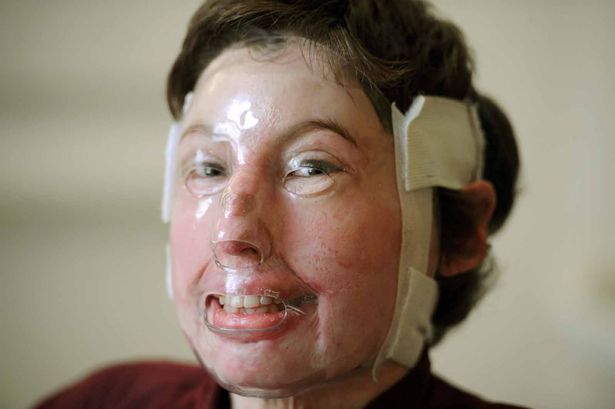 Wrexham Alps fireball victim joining forces with acid attack model charity