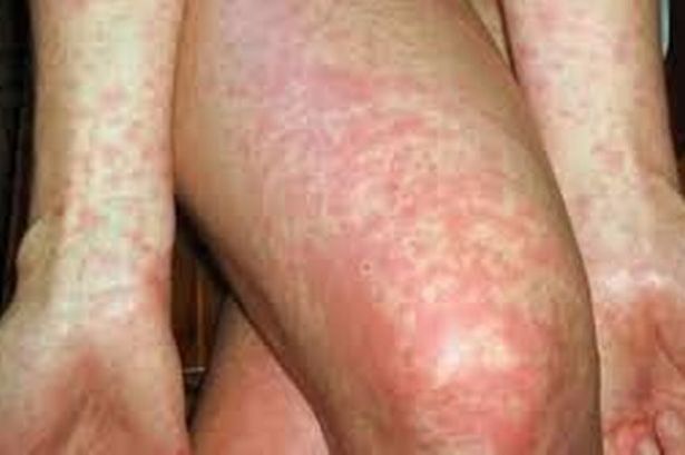 Scarlet Fever cases rise in Conwy, Denbighshire and Anglesey