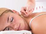Acupuncture does work for pain if twisted correctly