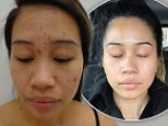 How woman, 26, cleared up her adult acne in 12 weeks