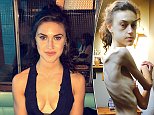 Anorexic says Instagram recovery accounts saved her