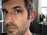 Filmmaker tweets snap of his bloodied eye