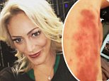 MAFS' Clare Verrall reveals her severely bruised legs