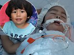Boy, 2, diagnosed with a vanishing bone disease