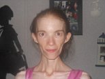 Anorexia patient who weighs 58lbs prepares for an early death