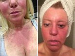 California fires cause bizarre outbreak of allergic rash reactions in residents