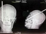Construction worker, 56, survives after being impaled by a 10ft long iron rod in the HEAD