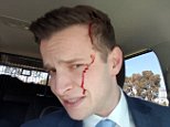 Reporter is left with blood dripping down his face after he’s attacked by a swooping magpie