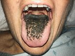 Woman's tongue turned BLACK and 'hairy' because of an antibiotic